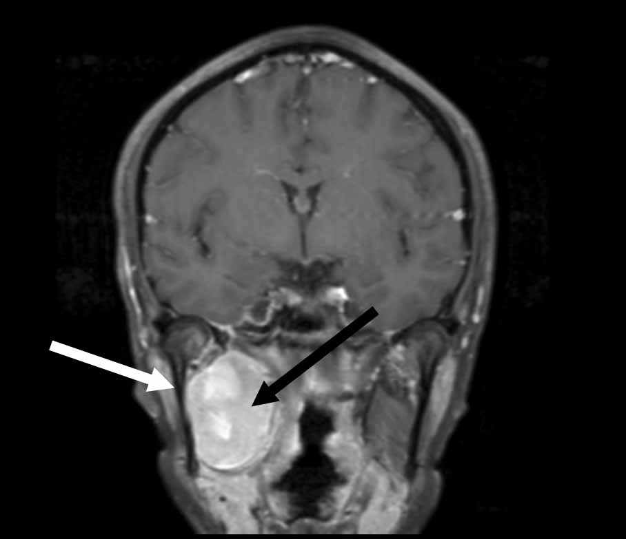 MRI image of my head showing tumor